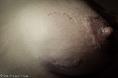 Bite mark on breast