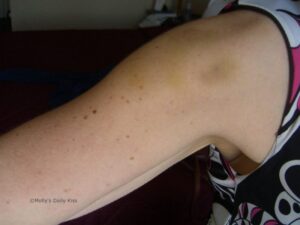 Bite mark bruises